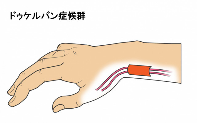 腱鞘炎のイラスト